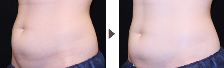 Treatment of abdominal area※ 12 weeks after one treatment 