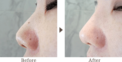 A tip of nose and a ridge of nose has been adjusted beautifully naturally to look like a modulated face