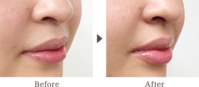 By injecting into the lips, vertical wrinkles become inconspicuous and finish to a fascinating lip.