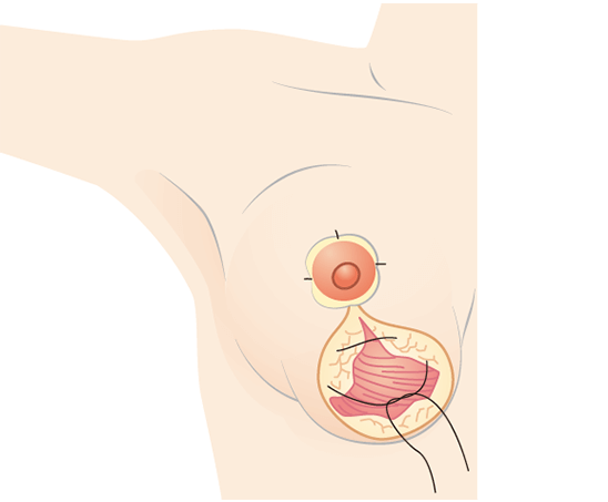 Suture the left and right fat layers