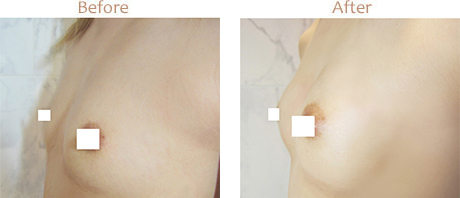 Hyaluronic Acid Big Breast Size Dermal Filler Breast Injection