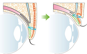 上まぶた二重埋没法